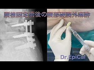 腰椎固定術後の腰部硬膜外麻酔 epidural anesthesia by Dr.EpiCal
