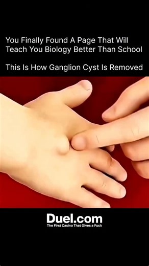 BIOLOGY | MEDICAL | HEALTH on Instagram: "A ganglion cyst is a small, fluid-filled lump that usually appears on the wrist or hand. To remove it, a doctor begins by cleaning and numbing the area. A tiny cut or a needle is used to drain the thick fluid inside. In some cases, the whole cyst sac is surgically removed so it doesn’t grow back. The procedure is quick, safe, and usually done as an outpatient treatment! DM for credit/removal #GanglionCyst #CystRemoval #MedicalProcedure #HealthAwareness #