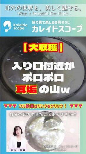【大収穫】入り口付近がボロボロ耳垢の山ｗ
