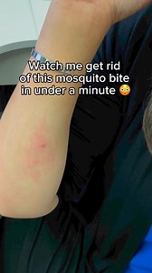 😳🤯 How fast can you get rid of a bug bite? 🦟 With Bug Bite Thing Suction Tool get rid of the discomfort from bug bites and stings in seconds! 🐝 This thing uses ONLY suction to remove the insects saliva or venom from under your skin, so no more itching, stinging, or swelling! 🤩🙌 💥 Get yours here! https://www.bugbitething.com/products/bug-bite-thing-suction-tool #BugBiteThing #SuctionTool #InsectBiteRelief #BugBites #MosquitoHack #Hack | Bug Bite Thing