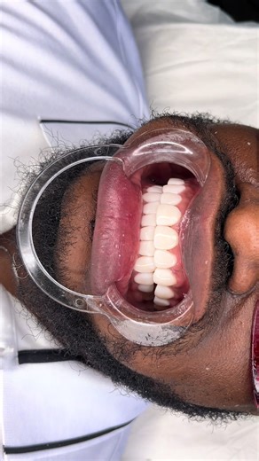 Our booking schedule is now open. Call or text us at 469-261-4604#fyp #veneers #trending #viral #dfw