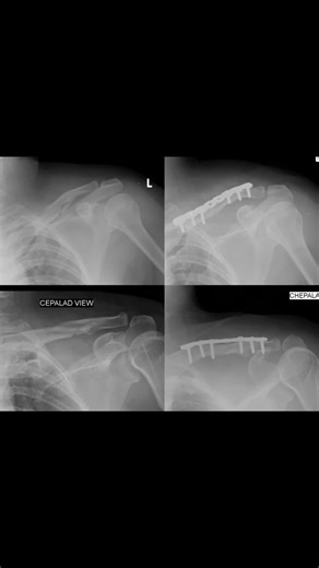 Pengertian Clavicula AP Cephalad dalam Radiologi