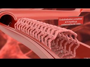 Στεφανιογραφία - Αγγειοπλαστική με τοποθέτηση Stent