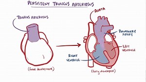 Video: Persistent truncus arteriosus - Video Explanation! | Osmosis | Osmosis