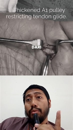 Operasi TRIGGER FINGER untuk jari yang nyangkut saat ditekuk ⁉️😱 #faktakesehatan #faktaunik #drbimo