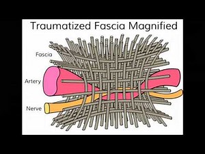 Treating Chronic Pain and Adhesions