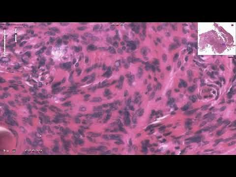 Meningioma - Histopathology
