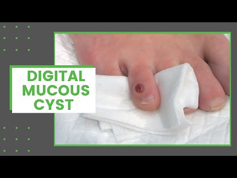 Digital Mucous Cyst | Dr. Derm