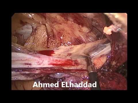 TAPP (Transabdominal Preperitoneal) for recurrent left oblique inguinal hernia