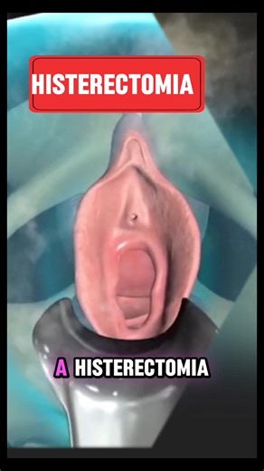 #CapCut #histerectomiatotalabdominal