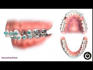 Upper First Premolar Extraction | Dental Braces | Temecula Valley, CA