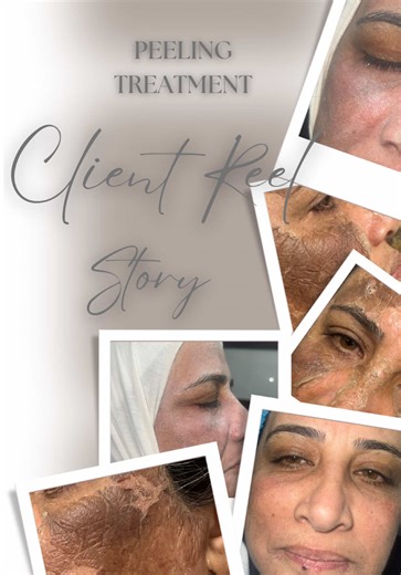 Peeling treatment ✨ Our beautiful client had severe sun damage and dark pigmentation for years. After her customized peeling session, her skin transformed into smooth, even-toned, baby-soft skin 🌸 Healthy glow. Clear complexion. Real results. #PeelingTreatment #SkinRenewal #SkinTransformation #GlowingSkin #FadiaKaramCosmetics