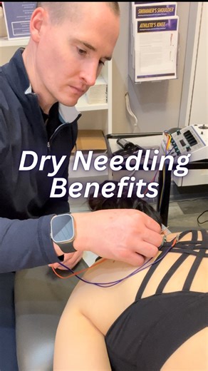 Dry Needling Benefits 🎯 Dry needling targets tight, overactive muscles and trigger points to reset tension and restore movement. Benefits: • reduces muscle tightness • improves blood flow • decreases nerve irritation • increases range of motion • speeds up recovery Common areas: ⚡ neck & suboccipitals (headaches) ⚡ upper traps & shoulder ⚡ low back & QL ⚡ hip flexors & glutes ⚡ calves & Achilles It’s not acupuncture — it’s movement-based muscle therapy that helps your body calm down and functio