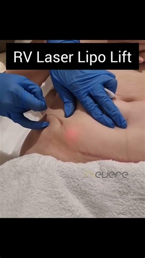 RV Laser Lipo Lift: Solusi Kencangkan Kulit & Bentuk Tubuh Tanpa Bedah