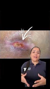 Parches Hidrocoloide, la solución para lesiones como úlceras de presión,comunes en paciente en cama.