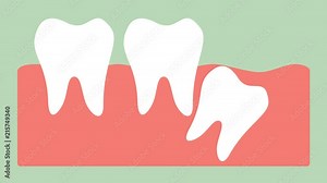 wisdom tooth ( distal impaction ) - dental cartoon vector flat style render 2d animation in 4K
