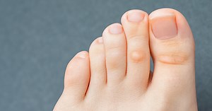 Causes and treatments for thick toenails