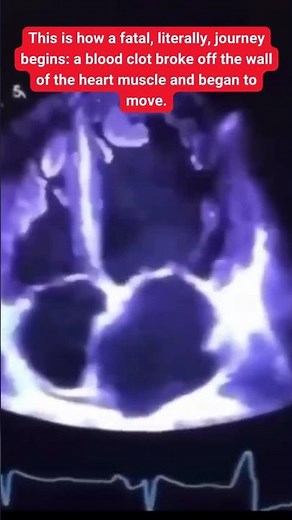 A blood clot broke off the wall of the heart muscle and began to move.