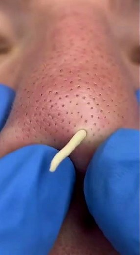 What Black Dots on Your Skin Could Really Mean! 🕵️‍♂️✨