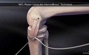 MCL Repair Using the InternalBrace™ Technique