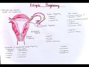 Ectopic Pregnancy - risk factors, types, diagnosis, treatment
