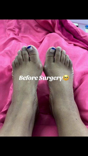 Bunion Surgery Recovery Journey: From Pain to Relief