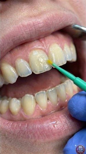 How Tooth Erosion Is Restored 🦷 Acid-Damaged Teeth Repair Explained