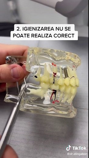 Pe intelesul turturor 🦷 #doctorgabor #drgaboralin #zambeste #dentist #romania #fy #doctor #pentrutine #drg #molariideminte #decesascoatemmolarii