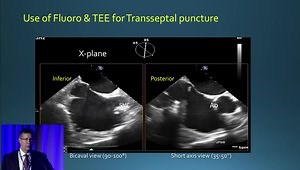 How to Implant Watchman: A Step-by-Step Guide