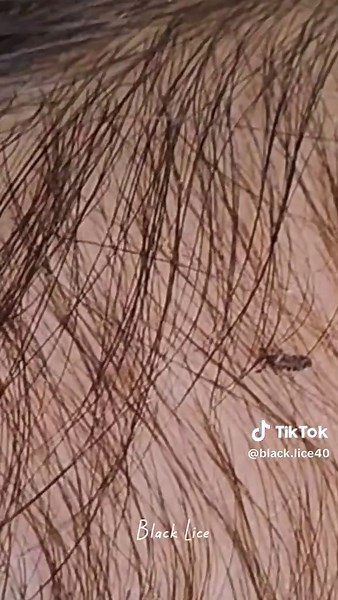 Lice Removal 333 #omg #lice #tripofobia #liceremoval #licetreatment #hairlice
