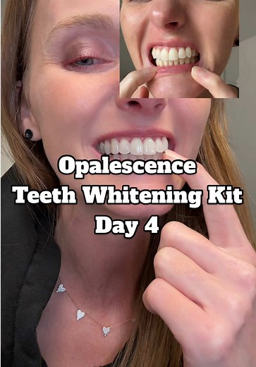 Opalescence Teeth Whitening Kit Review: Day 4 Results