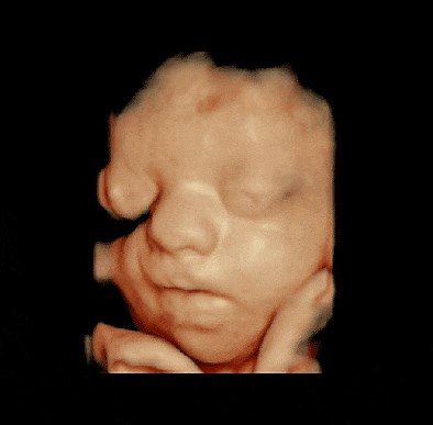 Ultrasonido Estructural | Especialistas en Medicina Fetal | Reina Madre