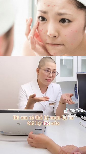 Trị mụn 1 lần có khỏi vĩnh viễn không?