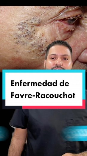 Enfermedad de Favre-Racouchot: Causas, Tratamiento y Prevención