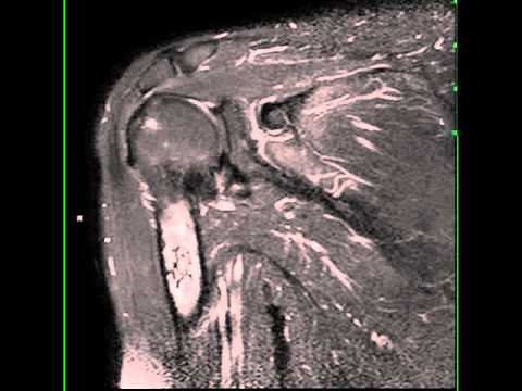 Bone Infarct, Humerus