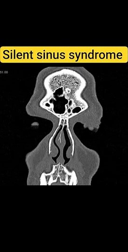 Case 103: silent sinus syndrome #ctscan #radiology #radiologist #mri #medical #medicalimaging