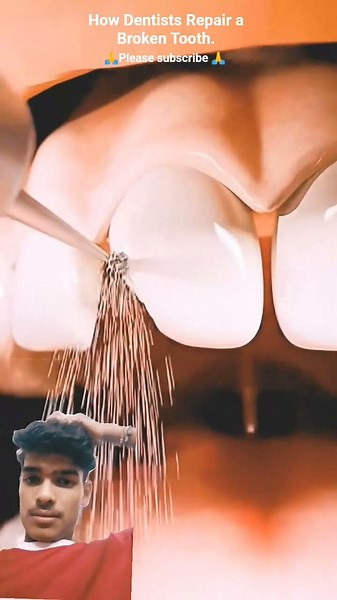 How Dentists Repair a Broken Tooth.