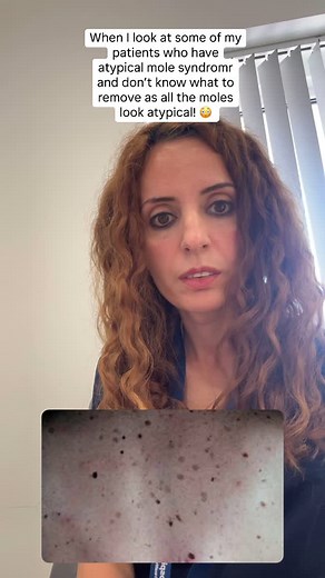 RIVERSIDE SKIN & LASER CLINIC | CHELMSFORD on Instagram: "🌟Dysplastic nevus syndrome (DNS), also known as atypical mole syndrome (AMS), is an inherited condition that causes a high number of atypical moles and an increased risk of melanoma. 🌟Symptoms: Atypical moles may be larger than normal moles, flat with raised areas, and have irregular or blurred edges. 🌟They may also be uneven in color, showing different shades of brown, black, and pink. ‼️👀We closely monitor these patients by taking r