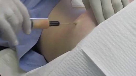 Chronic ankle sprain and instability injections and treatments