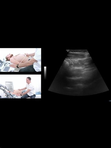 Understanding Ultrasound of the Gastrointestinal Tract