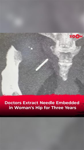 Experience the astounding journey of medical prowess as doctors extract a needle embedded in a woman's hip for three years. Don't miss out, watch the video to learn more! . . #zoomtv #health #healthcare #healthylifestyle #fyp #trending | Zoom TV