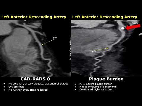 Coronary CT Angiography (CCTA) Normal (CAD-RADS 0) Vs CAD-RADS 2 Cases | Mild Atherosclerosis
