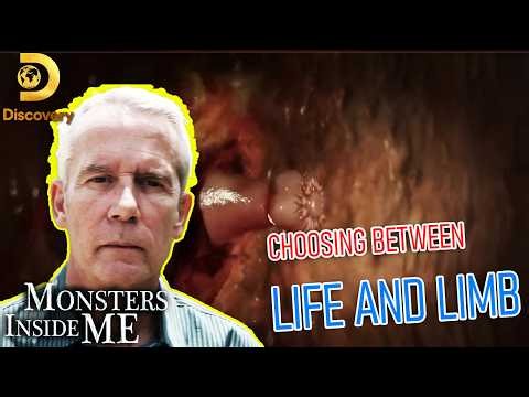 Monsters Inside Me Full Episodes | S04E03⚡ Choosing Between Life and Limb⚡ | Medical Examiner 2026