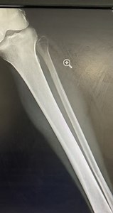 Diagnosis? Can you see the fissure ?🦴 | Radiology - 1895