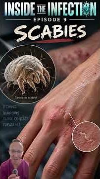 scabies