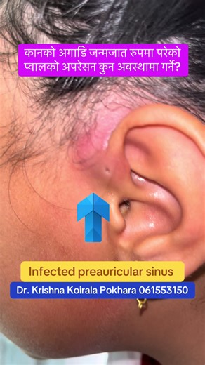 Managing Infected Preauricular Sinus: When is Surgery Necessary?