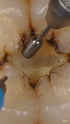 Small Black Spot in Tooth Cavity Cleaning Removal Teeth Cleaning Dental teeth cleaning #shortsviral