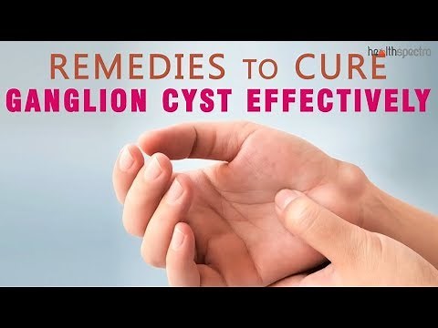 10 Remedies to Cure Ganglion Cyst Effectively