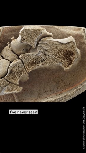 Photon-counting CT supports musculoskeletal diagnoses by helping physicians detect even subtle abnormalities. | Siemens Healthineers