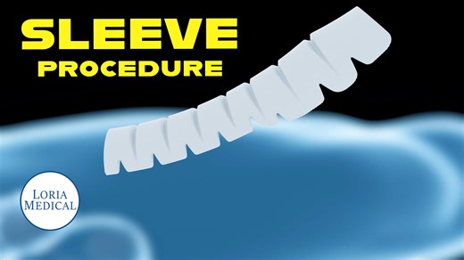 LorSleeve Penile Lengthening & Girth Enhancement Surgery (Update 2025)